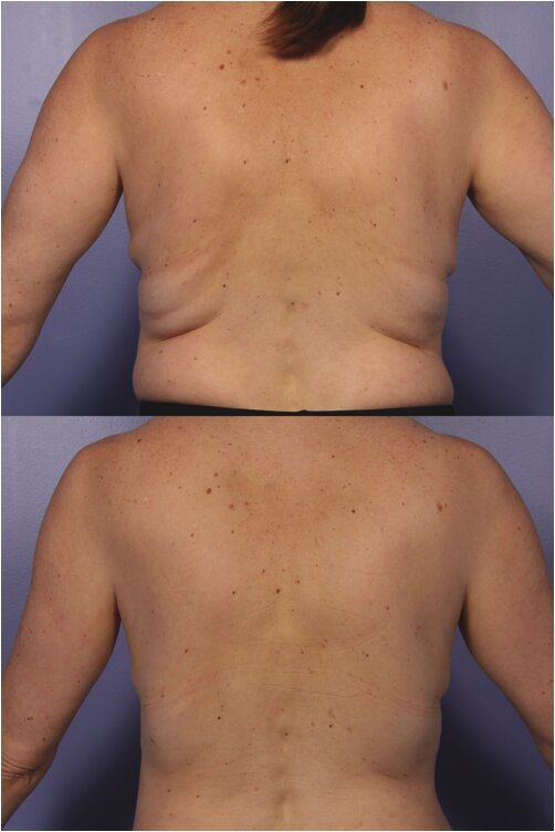 CoolSculpting before and after - woman's back