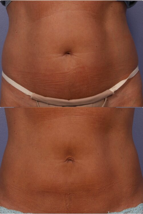 CoolSculpting before and after woman's stomach area