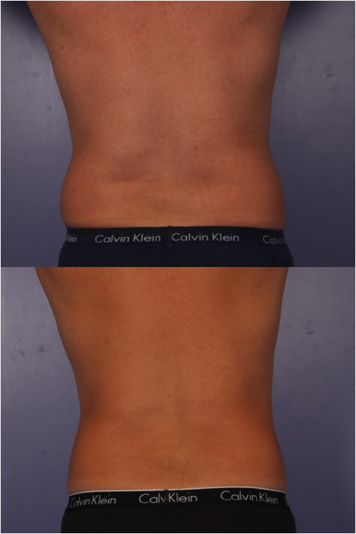 CoolSculpting before and after - woman's back and sides