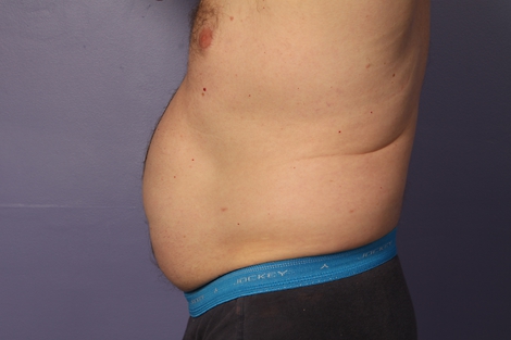 CoolSculpting Before & After Image