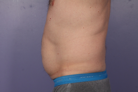 CoolSculpting Before & After Image