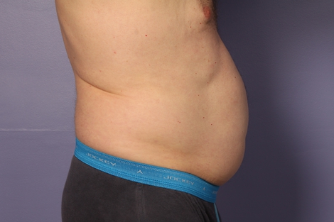 CoolSculpting Before & After Image