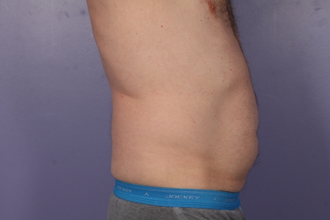 CoolSculpting Before & After Image