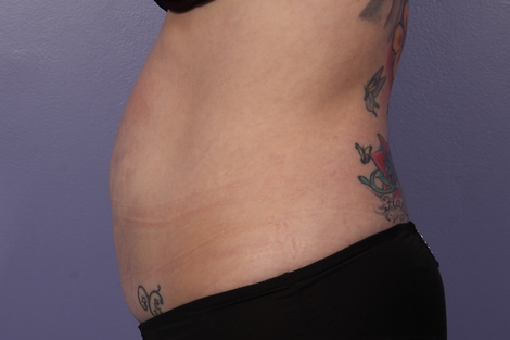 CoolSculpting Before & After Image