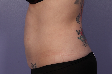 CoolSculpting Before & After Image