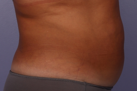 CoolSculpting Before & After Image