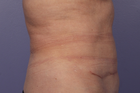 CoolSculpting Before & After Image