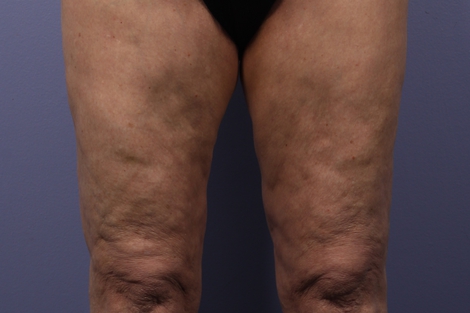 CoolSculpting Before & After Image