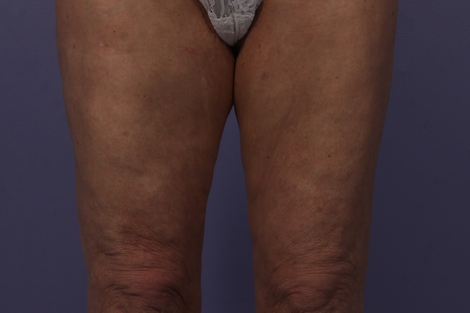 CoolSculpting Before & After Image