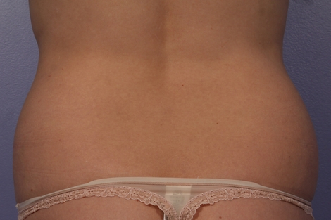 CoolSculpting Before & After Image