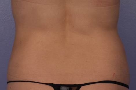 CoolSculpting Before & After Image