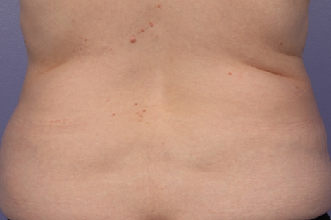 CoolSculpting Before & After Image