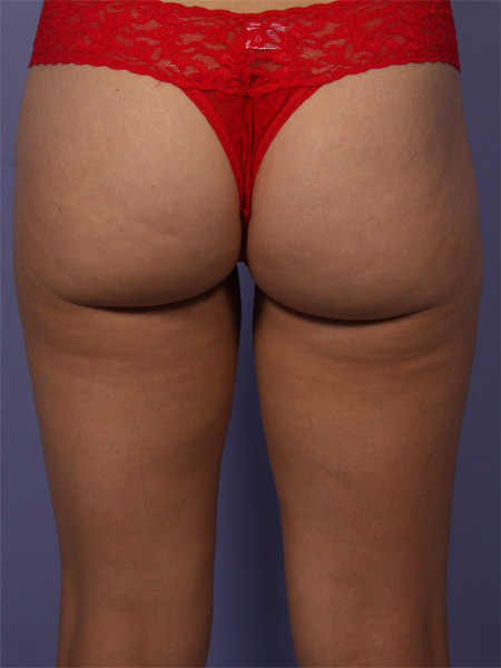 CoolSculpting Before & After Image