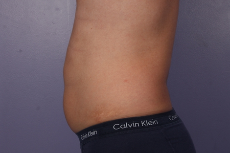 CoolSculpting Before & After Image