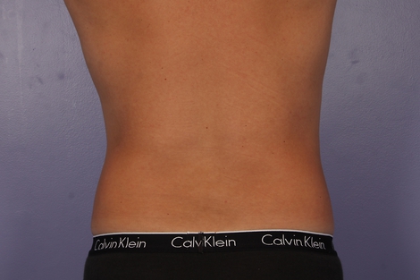 CoolSculpting Before & After Image