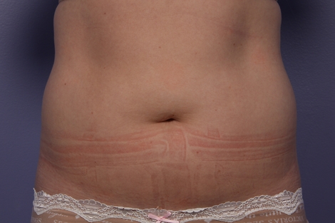 CoolSculpting Before & After Image