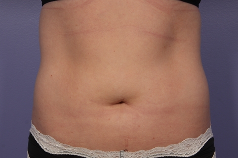 CoolSculpting Before & After Image