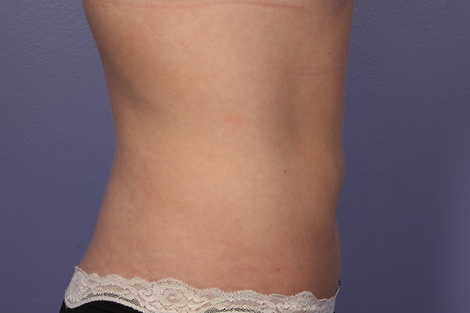 CoolSculpting Before & After Image