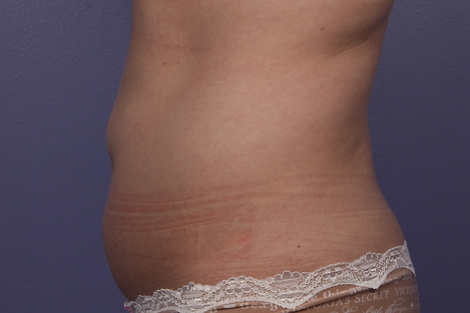 CoolSculpting Before & After Image