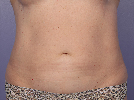 CoolSculpting Before & After Image