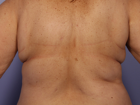 CoolSculpting Before & After Image