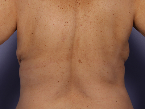 CoolSculpting Before & After Image