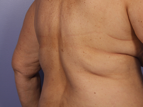 CoolSculpting Before & After Image