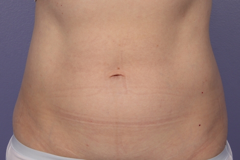 CoolSculpting Before & After Image