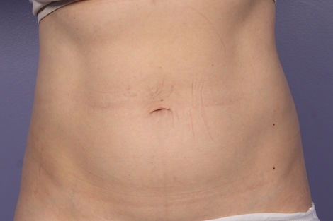 CoolSculpting Before & After Image