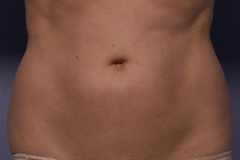 CoolSculpting Before & After Image