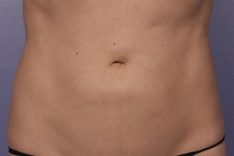 CoolSculpting Before & After Image