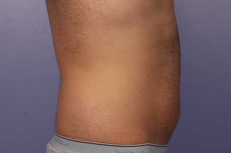 CoolSculpting Before & After Image