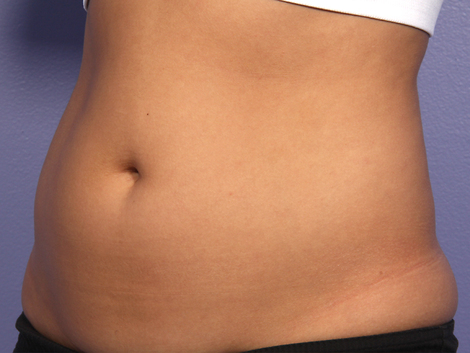 CoolSculpting Before & After Image