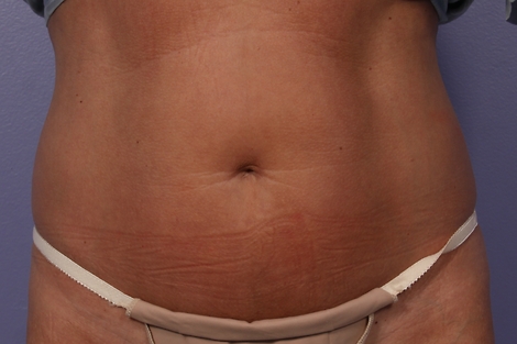 CoolSculpting Before & After Image