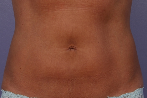 CoolSculpting Before & After Image