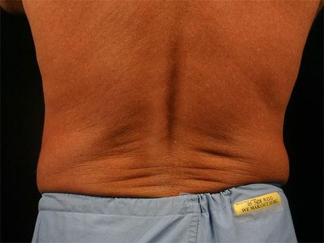 CoolSculpting Before & After Image