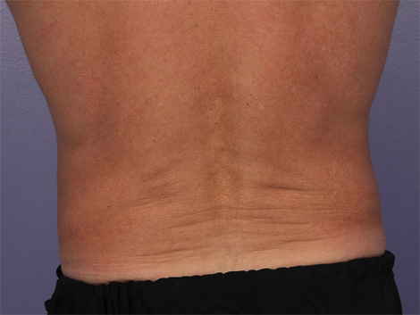 CoolSculpting Before & After Image