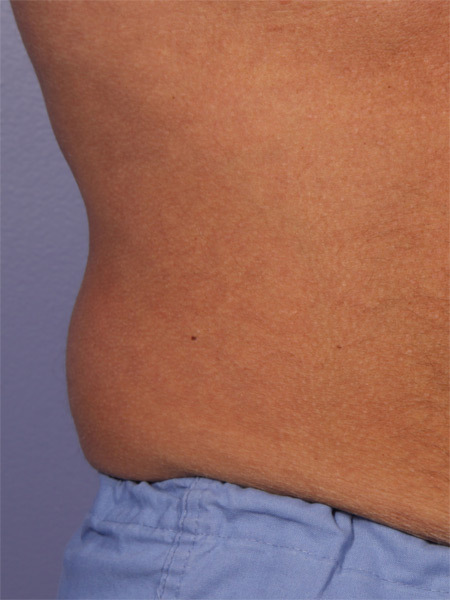 CoolSculpting Before & After Image