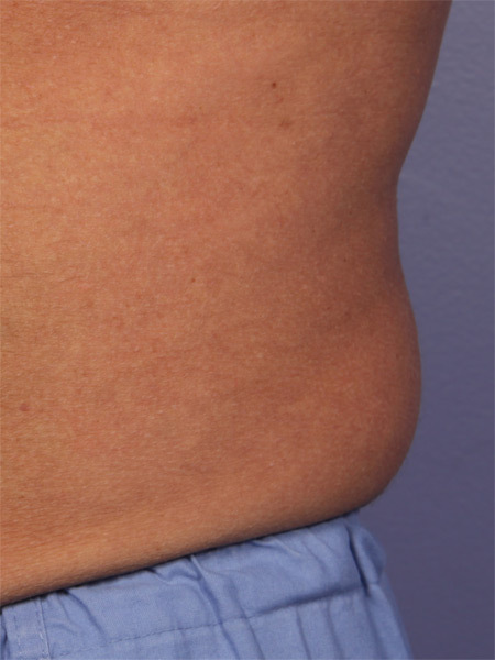 CoolSculpting Before & After Image