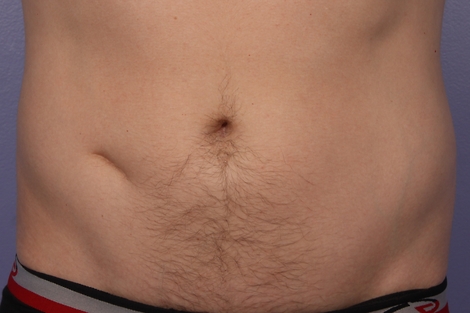 CoolSculpting Before & After Image