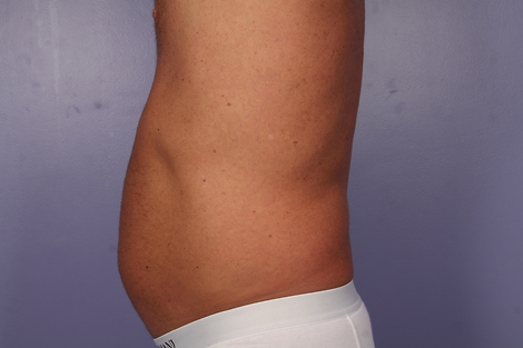 CoolSculpting Before & After Image