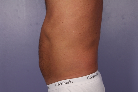 CoolSculpting Before & After Image