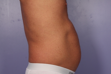 CoolSculpting Before & After Image