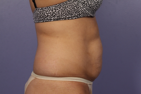 CoolSculpting Before & After Image