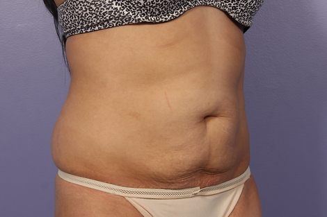 CoolSculpting Before & After Image