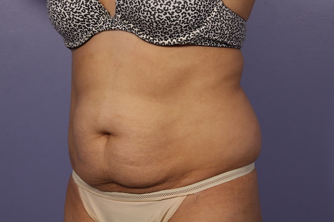 CoolSculpting Before & After Image