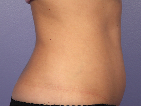 CoolSculpting Before & After Image