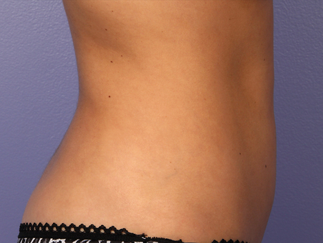 CoolSculpting Before & After Image