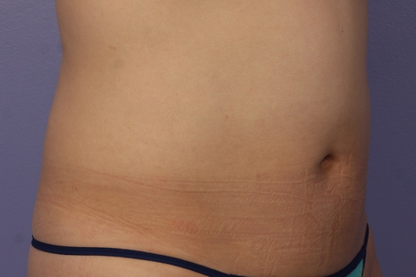 CoolSculpting Before & After Image