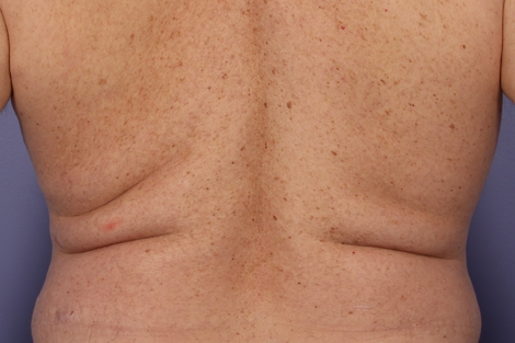 CoolSculpting Before & After Image